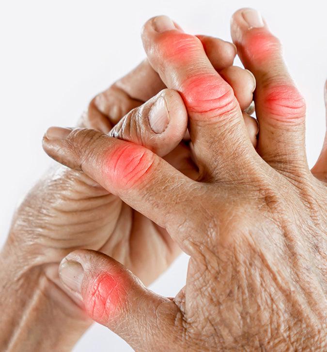Oxidative stress and rheumatoid arthritis.